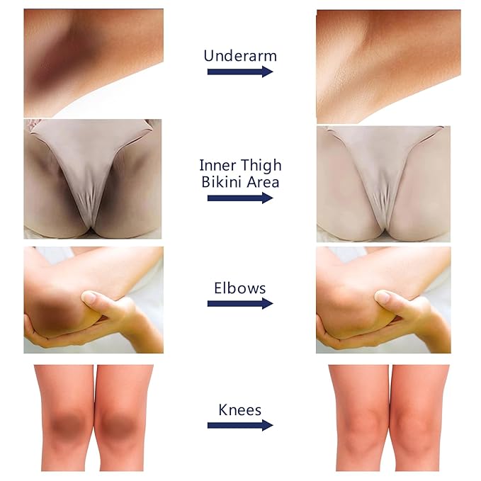 Whitening Cream For Dark Skin Underarm