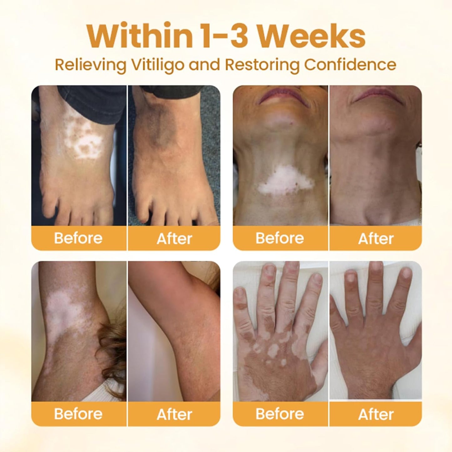 Bee Venom Cream, Vitiligo Bee Venom Skin Treatment Cream, Vitiligo Care cream Hydrating Moisturizing for All Men and Women's Skin Types