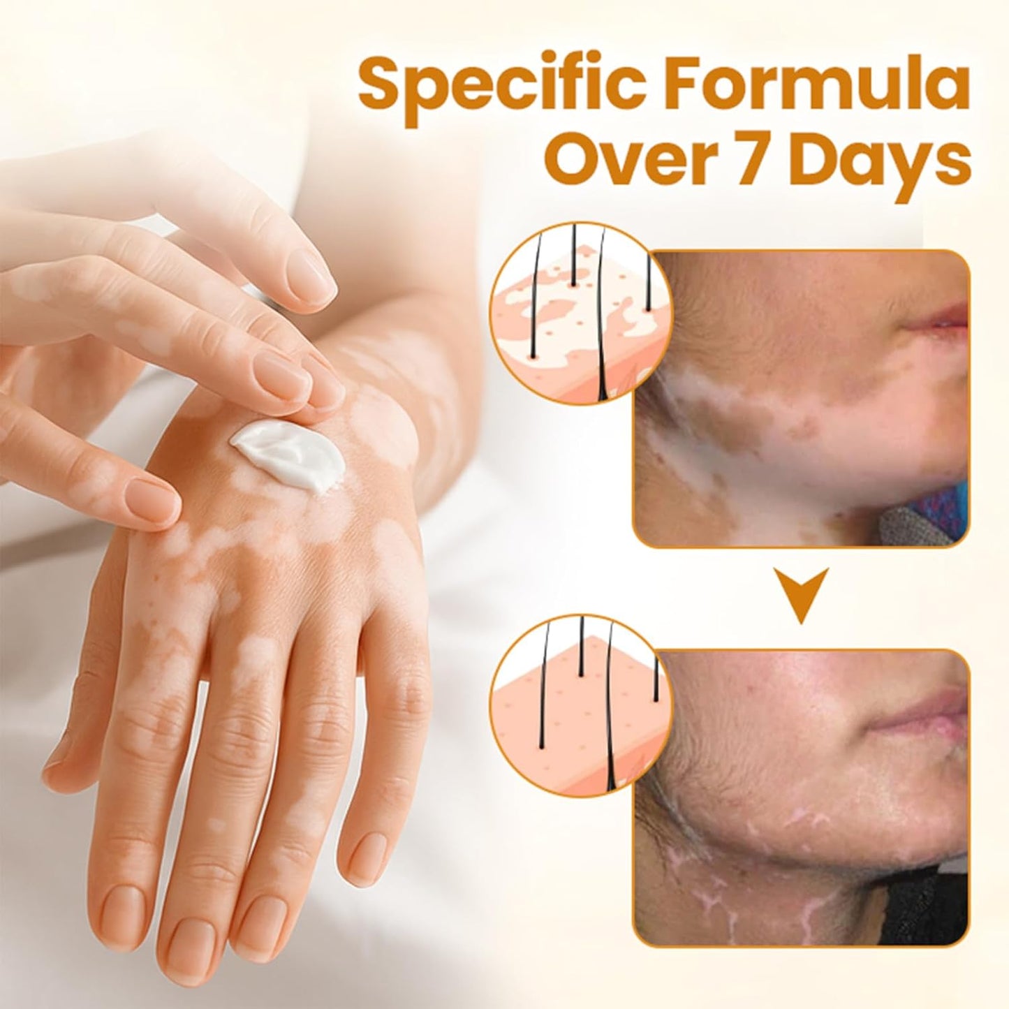 Bee Venom Cream, Vitiligo Bee Venom Skin Treatment Cream, Vitiligo Care cream Hydrating Moisturizing for All Men and Women's Skin Types