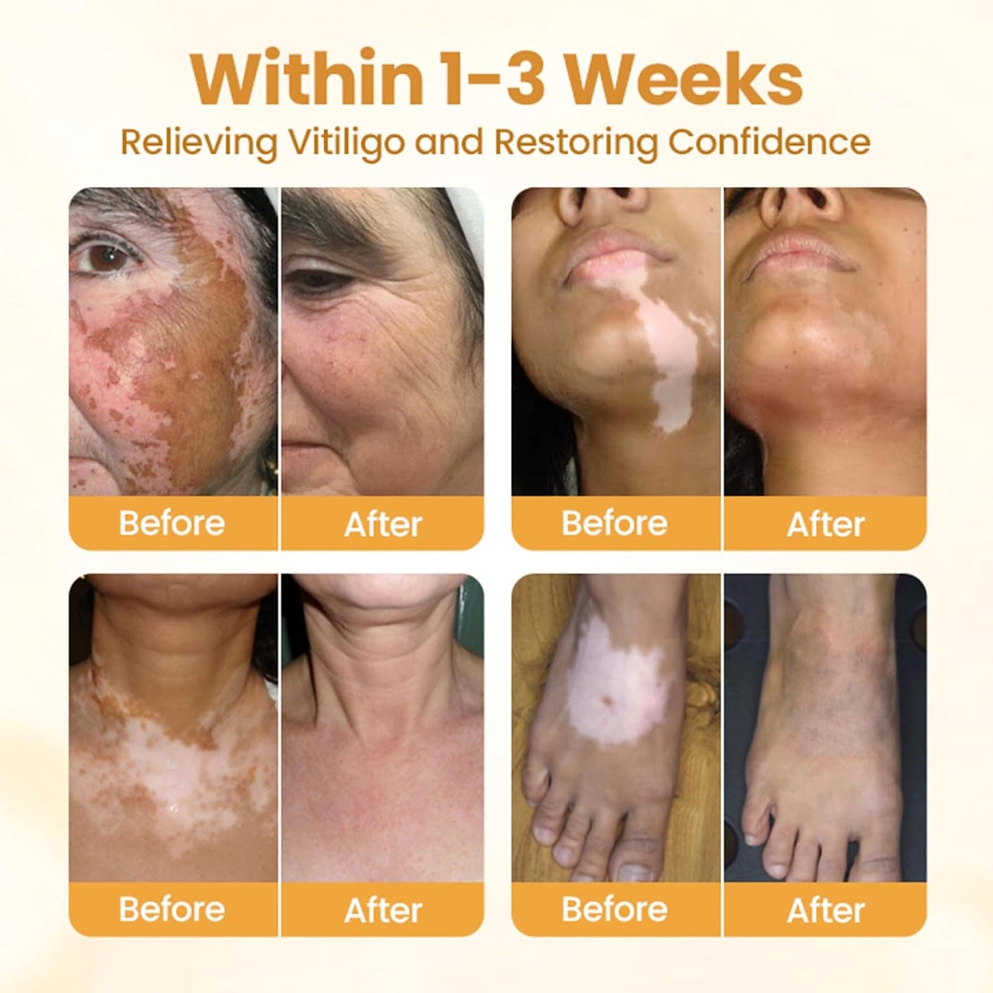 Bee Venom Cream, Vitiligo Bee Venom Skin Treatment Cream, Vitiligo Care cream Hydrating Moisturizing for All Men and Women's Skin Types