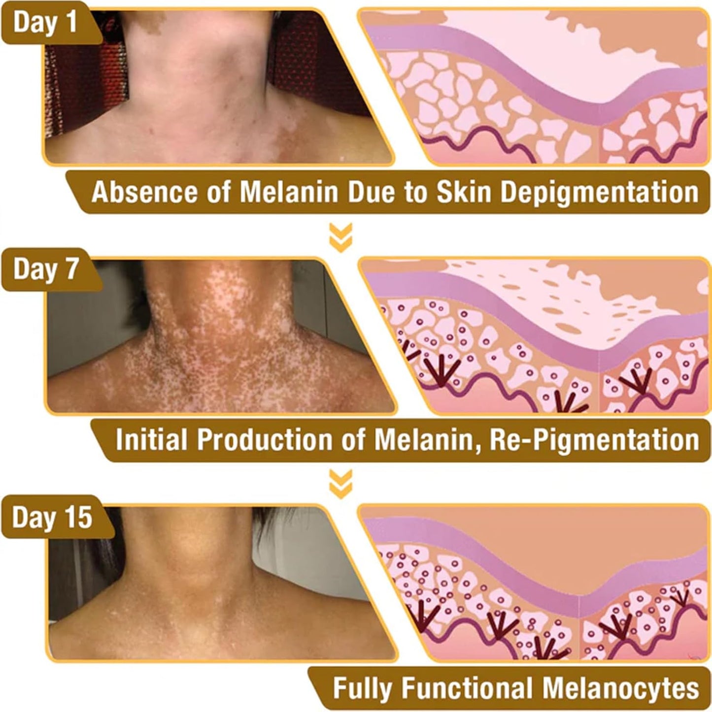 Bee Venom Cream, Vitiligo Bee Venom Skin Treatment Cream, Vitiligo Care cream Hydrating Moisturizing for All Men and Women's Skin Types