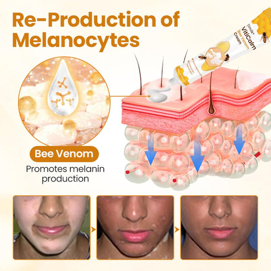 Bee Venom Cream, Vitiligo Bee Venom Skin Treatment Cream, Vitiligo Care cream Hydrating Moisturizing for All Men and Women's Skin Types