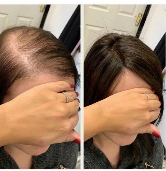 Wellice Onion Oil+ Shampoo (Pack of 2)- 2 months Challenge