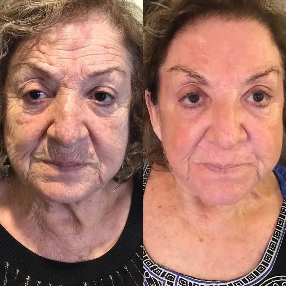 Bee Venom Wrinkle Removal Cream, Anti-Aging, Restore and Enhance Skin Elasticity, Natural and Non-Irritating, Suitable for Sensitive, Dry, Oily Skin