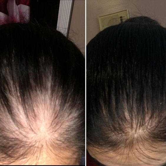 Wellice Onion Oil+ Shampoo (Pack of 2)- 2 months Challenge